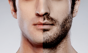 greffe de barbe greffe de barbe