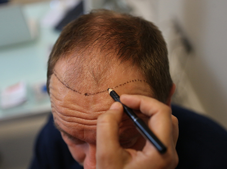 Haartransplantation